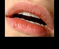 Герпес на губах - виновато ослабление иммунитета