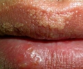 Белые точки на губе: причины их появления и лечение